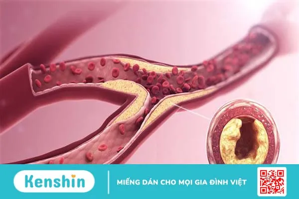 Viêm tắc động mạch là gì? Triệu chứng và phương pháp điều trị 1