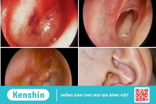 Viêm tai giữa mạn tính thủng nhĩ có nguy hiểm không?