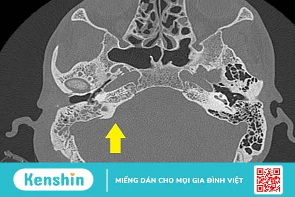 Viêm tai xương chũm mạn tính: Triệu chứng, cách điều trị1