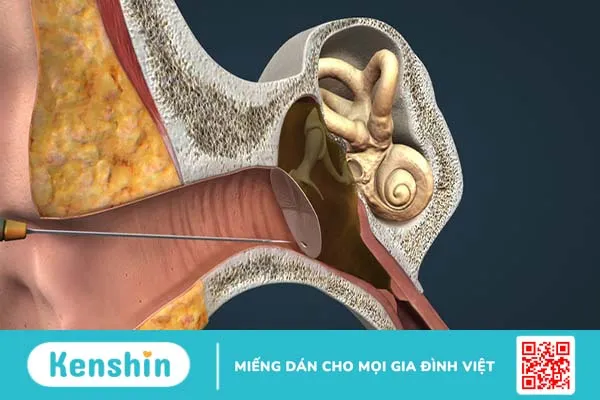 Hỏi đáp: Viêm thượng nhĩ là gì? 1