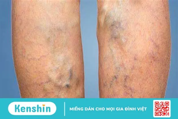 Viêm tĩnh mạch: Nguyên nhân, triệu chứng và cách điều trị bệnh 1