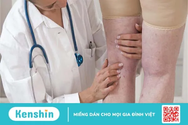 Viêm tĩnh mạch: Nguyên nhân, triệu chứng và cách điều trị bệnh 3