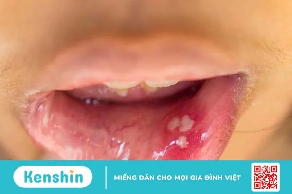 Virus HPV lây qua đường nào và có thể gây ra những bệnh gì?