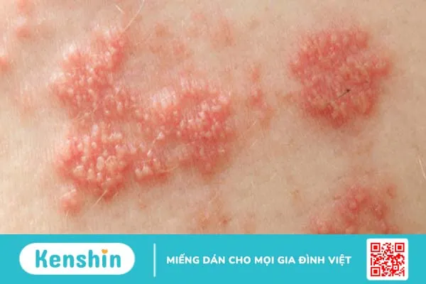 Virus HPV lây qua đường nào và có thể gây ra những bệnh gì? 1