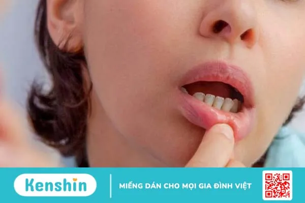 Vitamin C chữa nhiệt miệng được không? Cách bổ sung vitamin hiệu quả ai cũng nên biết 2