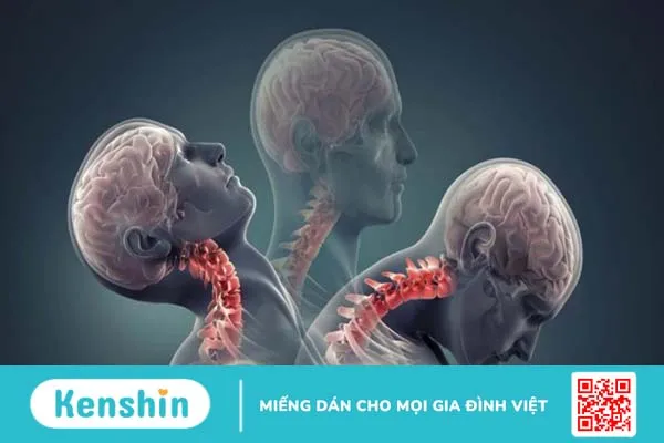 Vôi hóa đốt sống cổ là gì? Có nguy hiểm không? 3