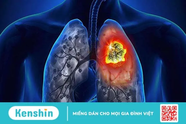 Vôi hóa phổi: Nguyên nhân và cách điều trị 3