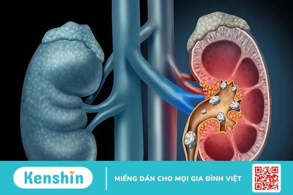 Vôi hóa thận: Nguyên nhân, triệu chứng và cách điều trị 3