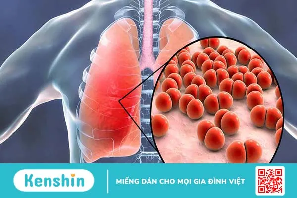 VPT là gì? Liệu VPT có phải là từ viết tắt bác sĩ sử dụng để chỉ bệnh viêm phổi thuỳ? 1