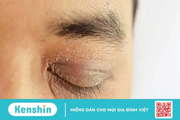 Vùng da quanh mắt bị khô ngứa là bệnh gì?1