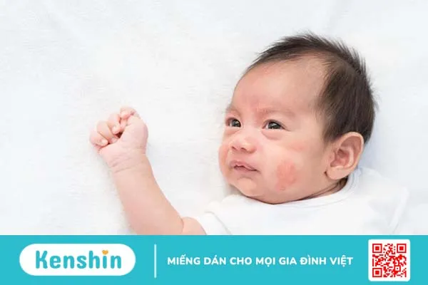 Vùng da quanh mắt bị khô ngứa là bệnh gì?2