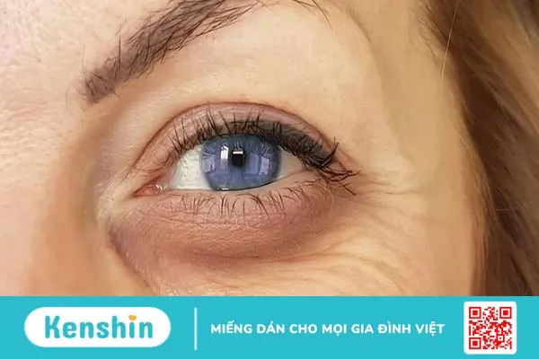 Vùng da quanh mắt bị khô ngứa là bệnh gì?3