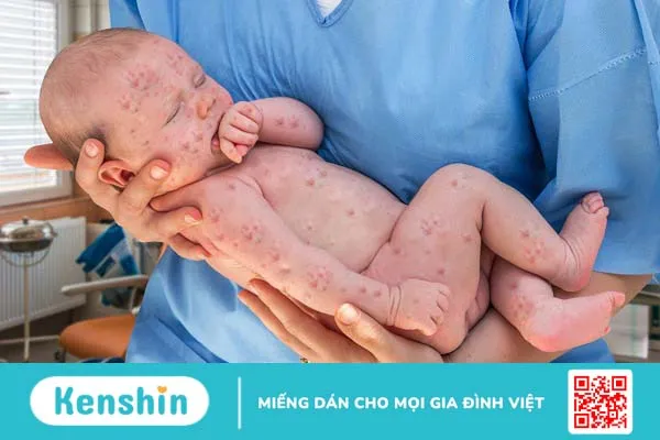 WHO cảnh báo hơn một nửa thế giới có nguy cơ bùng phát bệnh sởi vào cuối năm 2024-1