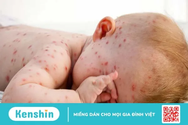 WHO cảnh báo hơn một nửa thế giới có nguy cơ bùng phát bệnh sởi vào cuối năm 2024-3