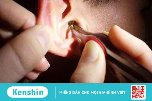 Xẹp nhĩ có nguy hiểm không? Phòng và điều trị như thế nào? 3