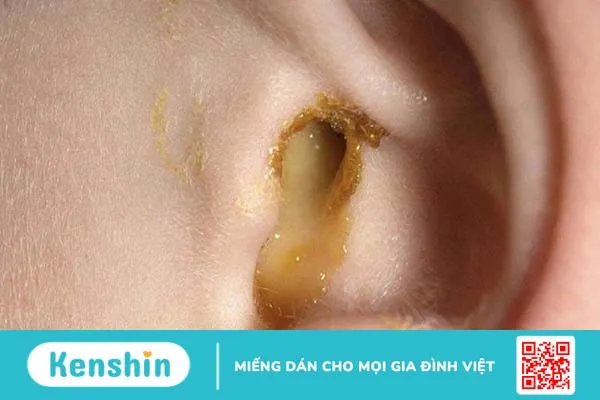 Xẹp nhĩ là gì? Mức độ nguy hiểm và cách điều trị như thế nào? 1