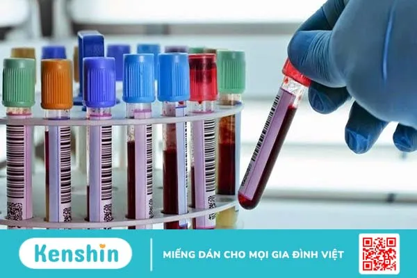 Mục đích và phương pháp xét nghiệm Anti Ds DNA 3