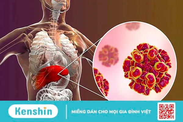 Xét nghiệm Anti HCV tìm kháng thể chống virus viêm gan C 1