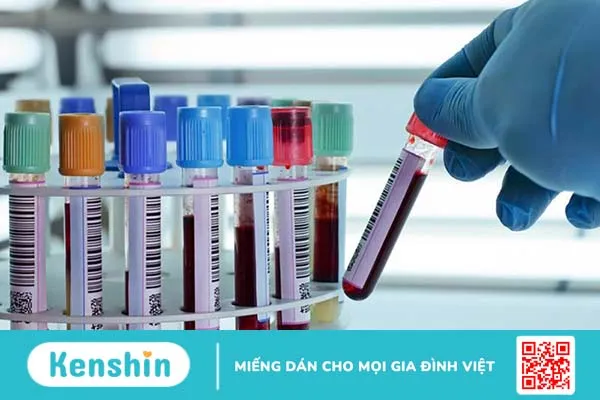 Xét nghiệm Anti HCV tìm kháng thể chống virus viêm gan C 3