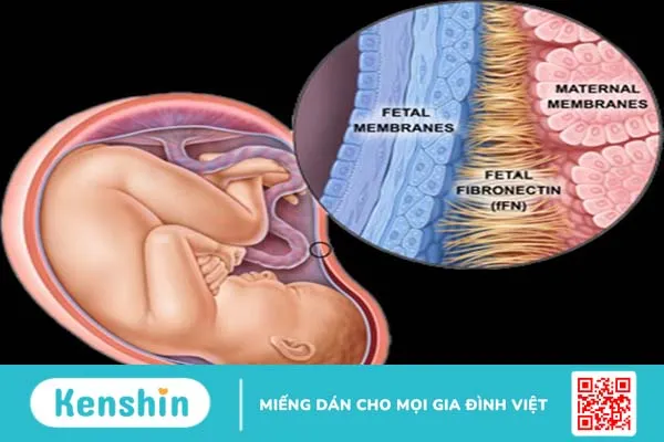 Xét nghiệm Fibronectin phát hiện nguy cơ sinh non 3