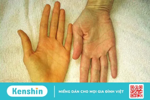 Xơ hóa gan là gì? Dấu hiệu và điều trị 1