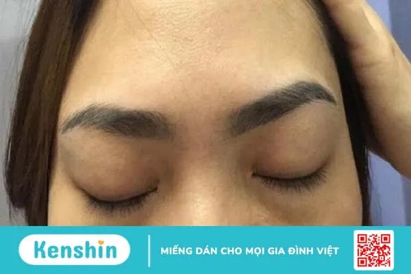 Xoá xăm chân mày bằng laser có hiệu quả không? 1