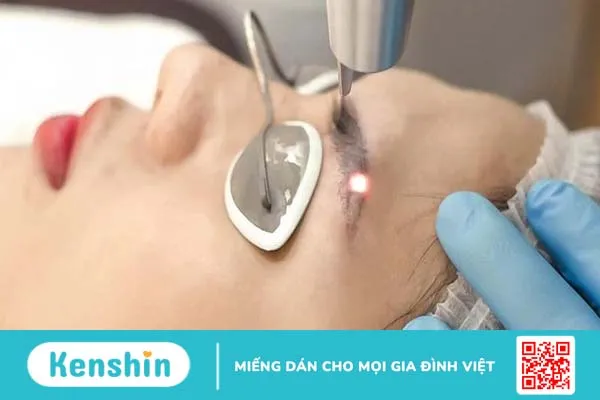 Xoá xăm chân mày bằng laser có hiệu quả không? 3