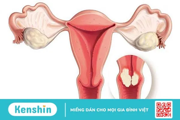 Xử trí khi u xơ cổ tử cung bị vỡ 1