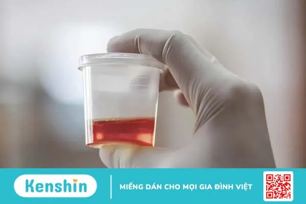 Xuất tinh ra máu là bệnh gì? Có nguy hiểm không? 1