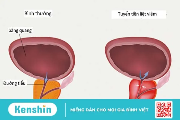 Xuất tinh ra máu là bệnh gì? Có nguy hiểm không? 3