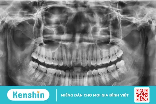 Xương hàm mỏng có niềng răng được không 1