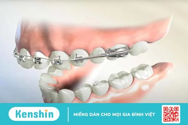 Xương hàm mỏng có niềng răng được không 3