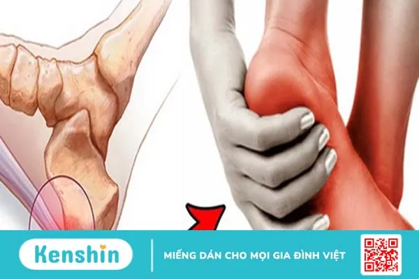 3 loại thuốc đặc trị viêm cân gan chân và cách phòng ngừa