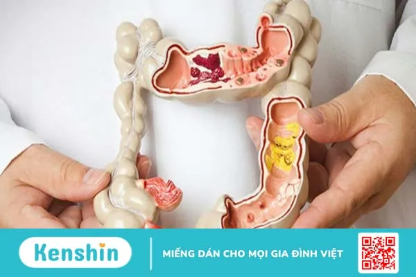 Ăn gì tốt cho bệnh đại tràng? Người bệnh đại tràng có cần kiêng gì không?