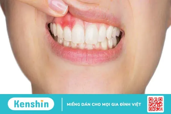 Ăn gì tốt cho nướu răng? Thực phẩm cần hạn chế nhằm bảo vệ răng miệng