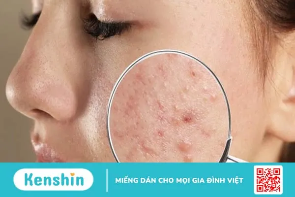 Ăn rau gì giảm mụn và tốt cho làn da?