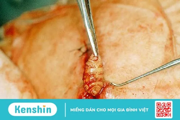 Ấu trùng ruồi Maggot gây bệnh gì? Nguyên nhân, triệu chứng và cách điều trị bệnh