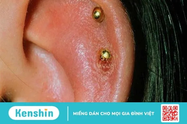 Bấm lỗ tai bị sưng mủ chảy máu – Giải quyết thế nào?