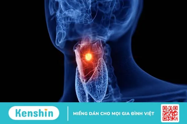 Bạn biết gì về các giai đoạn ung thư thanh quản?