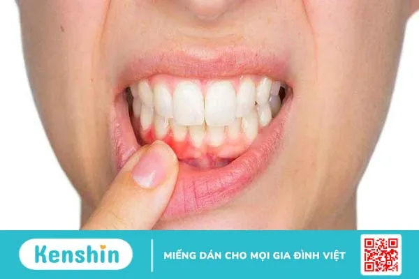 Bạn có muốn biết cách đánh răng không bị tụt lợi hay không?