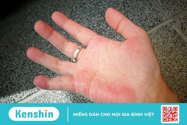 Bàn tay son có phải dấu hiệu cảnh báo bệnh gan không?