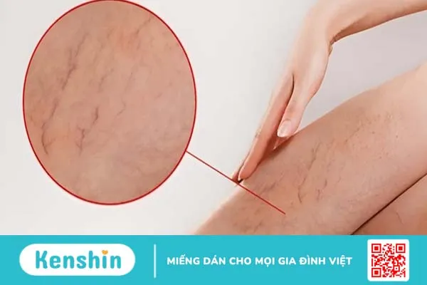 Bật mí cách xoa bóp giãn tĩnh mạch hiệu quả