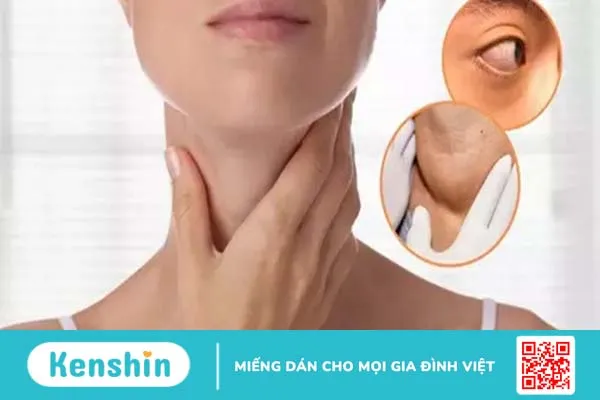 Bệnh bướu cổ basedow có chữa khỏi được không? Một số lưu ý phòng bệnh