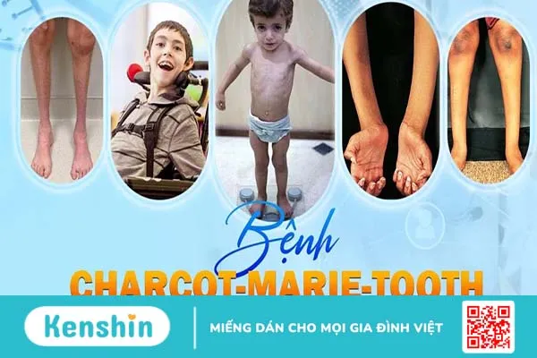 Bệnh Charcot-Marie-Tooth là bệnh gì?