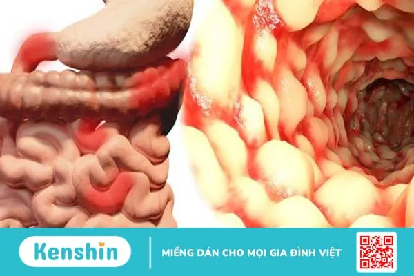 Bệnh Crohn của đại tràng – Nguyên nhân và phương pháp điều trị hiệu quả