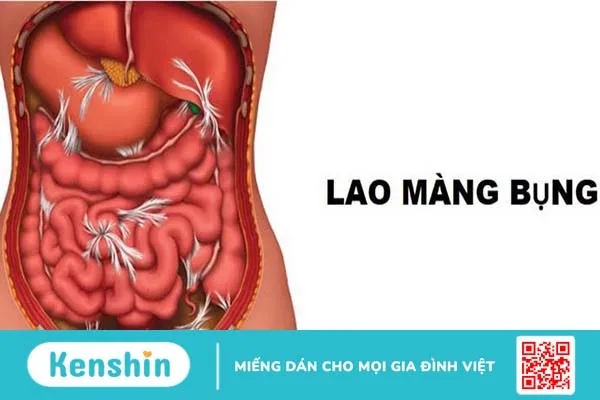 Bệnh lao màng bụng có nguy hiểm không?