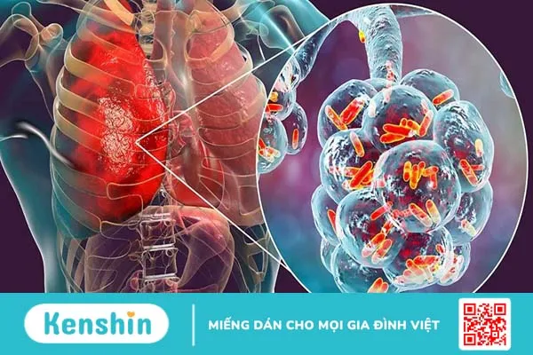 Bệnh Legionella nguyên nhân do đâu? Cách điều trị ra sao?