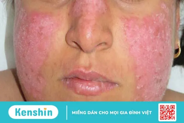 Bệnh lupus ban đỏ có di truyền không?