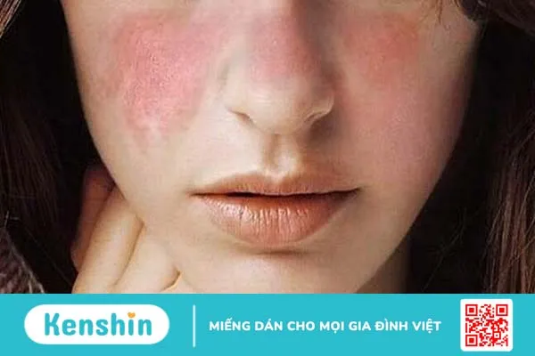 Bệnh lý lupus ban đỏ hệ thống có khả năng di truyền không?