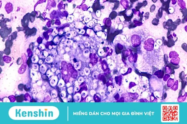 Bệnh nấm Histoplasmosis là bệnh gì? Triệu chứng và phương pháp điều trị